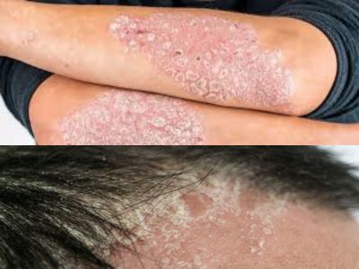 Psoriasis Treatment in Pakistan