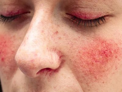 Rosacea Treatment in Pakistan
