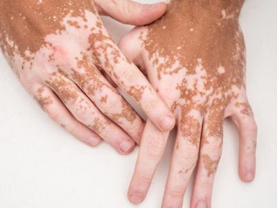 Vitiligo Treatment in Pakistan